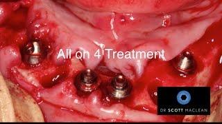 All on 4 Bridge Insert - DENTAL IMPLANTS