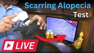 Dr. Mukesh Aggarwal Explains Scarring Alopecia with Live Scalp Demo