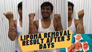 Lipoma Treatment Result After 3 Days ! Lipoma Removal Result ! Lipoma Natural Treatment #lipoma