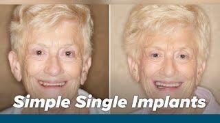 Barbara's Implant Success Story | HCI Dentistry (formerly Whitefield Dental)