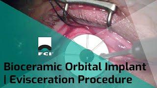 Bioceramic Orbital Implant | Evisceration| Procedure | Exclusive | FCI Orbital