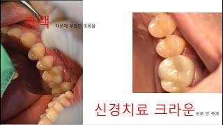 [부산치과잘하는곳] 크랙으로 인해 잇몸이 부은 치아를 신경치료 지르코니아 크라운으로 치료 (광안리 뉴욕치과 7-13-2)