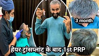 हेयर ट्रांसप्लांट PRP kya hota hai | What is PRP hair treatment #SuperSharmajiVlog