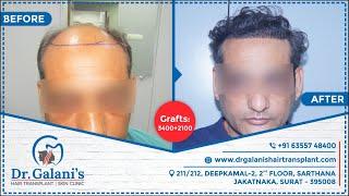 Best Hair Transplant In Surat 2021 | Fue - No Root Touch Surgery | Before And After 3400+2100 Grafts