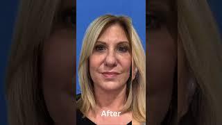 Dr. Amir Karam's INCREDIBLE Vertical Restore Facelift Transformations!