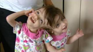 Conjoined Twins: Twin Girls, A Medical Wonder