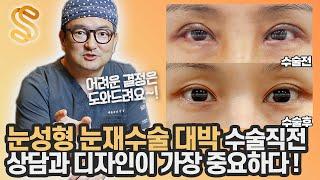 눈성형 눈재수술, 의사와의 티키타카 상담+수술직전 디자인 결정이 가장 중요하다!