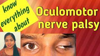 oculomotor ( 3rd cranial) nerve palsy// Aberrant Regenaration// Ophthalmology// MBBS// Optometry