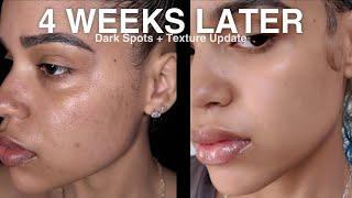 I Tried the VIRAL Acne Scar Kit for 4 Weeks — Here's What Happened | Vanessa Lynn