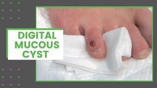 Digital Mucous Cyst | Dr. Derm