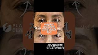 플라즈마블라스트로 자연스럽게 상안검리프팅, 이마주름리프팅하기 1회 6개월 후