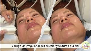 Rejuvenecimiento Facial, Ojos, Cuello y Manos con láser en Paloma Clinic Spa