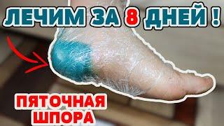 Как я вылечила ПЯТОЧНУЮ ШПОРУ за 8 дней!  Просто и Легко в домашних условиях народными средствами !