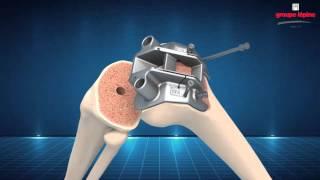 NEW WAVE Surgical Technique 3D Animation