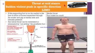 Transtibial gait deviation