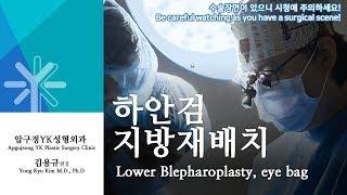 Lower blepharoplasty. eye bag, 하안검, 하안검 지방재배치