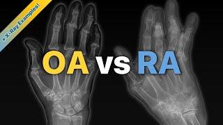 Osteoarthritis (OA) vs Rheumatoid Arthritis (RA): Explained! (+ X-Ray Examples)