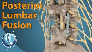 Posterior Lumbar Fusion