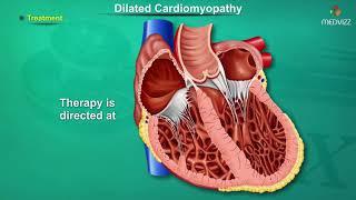 Dilated cardiomyopathy ( DCM ) : Causes, Signs and Symptoms, Pathogenesis, Diagnosis, and Treatment