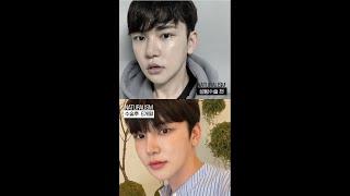 자연주의성형외과 코재수술+이마지방이식 수술 전후영상