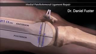 Reconstrucción ligamento patelofemoral medial