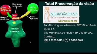 Meningioma - Risco de Perda da Visão - Tumor do Tuberculum Selae