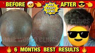 6months Best Results in Tamilnadu | Before & After Hair Transplant Results | Hair World Clinics