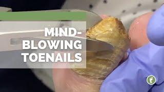 MINDBLOWING TOENAILS