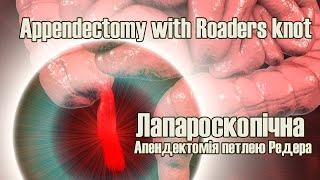 Appendectomy with Roaders knot / Апендектомія петлею Редера