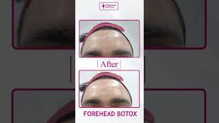 Experience the stunning before-and-after results of forehead Botox at Singhania Skin Clinic.