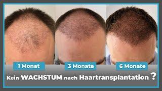 3 - 6 Monate nach Haarverpflanzung: Wann setzt das WACHSTUM endlich ein?