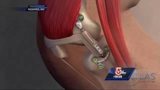 Could patients avoid knee replacement surgery with new implant?