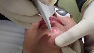 Freckles Removal Laser Treatment in Delhi ! Best Dermatologist in Delhi