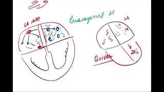 Atrial Fibrillation - Pathophysiology and Clinical
