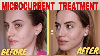 MICROCURRENT FACIAL BEFORE AND AFTER | NUOVALUCE MICROCURRENT REVIEW 2021 | Madella Beauty