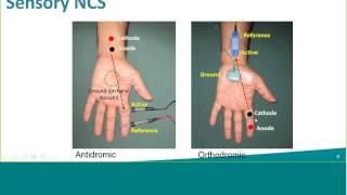 Natus NCS Webinar: Sensory NCS: Reducing Noise, Interference, & Artifacts