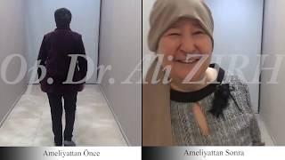 Emina DZAPPAROVA / Parkinson Beyin Pili Ameliyatı Öncesi ve 3 Hafta Sonrası