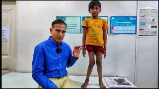 Unhealthy Lifestyle and Knock Knees in Children