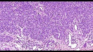 Back to Basics  melanoma variants Phillip McKee Part #1