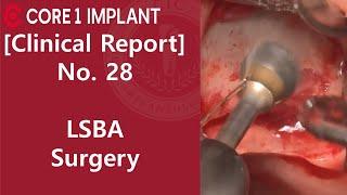 [CYBERMED Clinical Report] #26, 27, 37 Implant with Lateral sinus bone augmentation