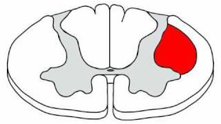 Anatomy Motor Exam: Spinal Cord Lesions