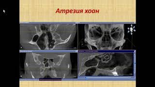 Зубарева А.А. «Диагностика полости носа и околоносовых пазух по данным КЛКТ»