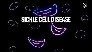 What is Sickle Cell Disease? And Can Science Cure it?