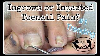 Impacted or Ingrown Toenail Pedicure Tutorial