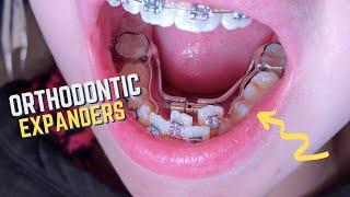 Braces Checkups - 11 year old patient - Upper and Lower Orthodontic Expanders - Tooth Time