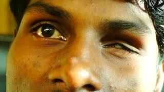 Artificial eye -My story of eye loss- Patient live -In Chhattisgarhi language