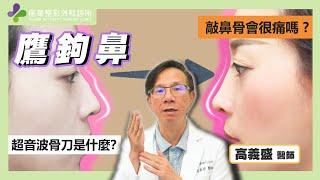 【風華聯合診所】敲鼻骨是很痛的手術嗎｜鷹鉤鼻治療方式｜超音波骨刀的應用｜高義盛醫師｜風華整形外科診所｜