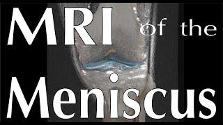 MRI of the Meniscus