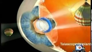 WPLG: CentraSight for age-related macular degeneration (AMD)