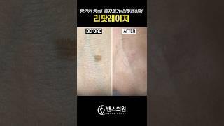 리팟레이저로 흑자 한번에 제거하기 #리팟 #흑자 #흑자레이저